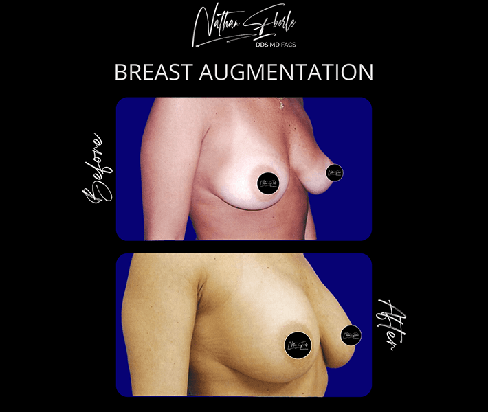 Breast Augmentation before and after - Actual Patient