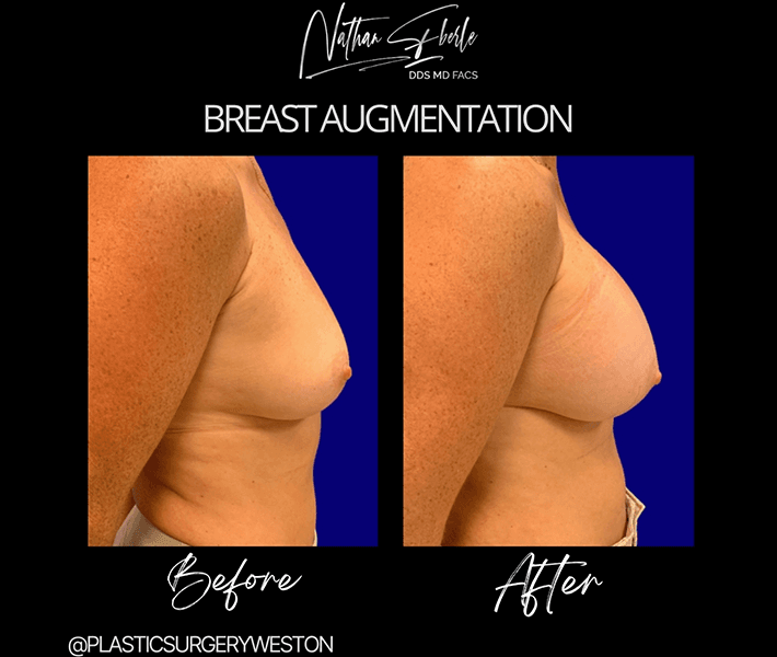 Breast Augmentation before and after - Actual Patient