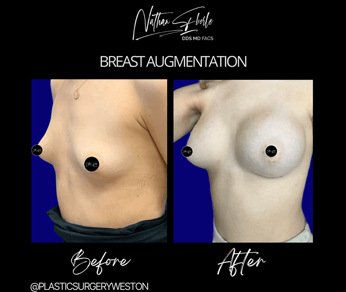 Breast Augmentation before and after - Actual Patient