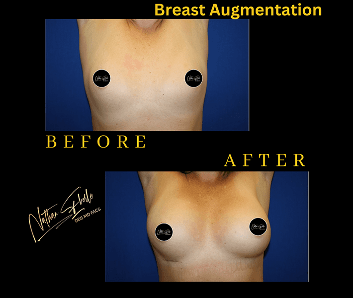 Breast Augmentation before and after - Actual Patient