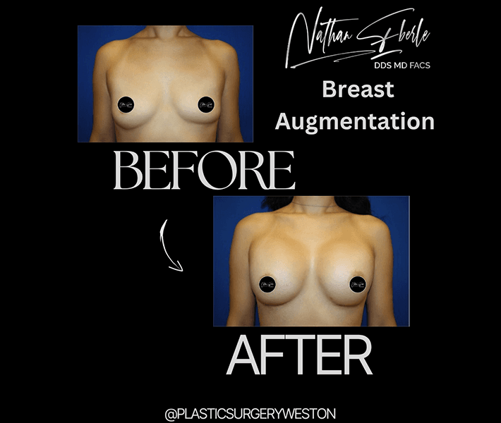 Breast Augmentation before and after - Actual Patient