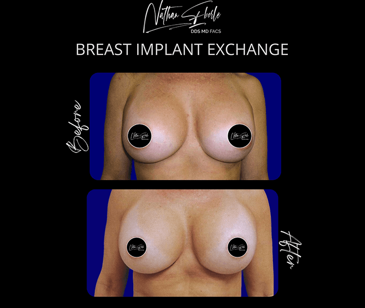 Breast Augmentation before and after - Actual Patient