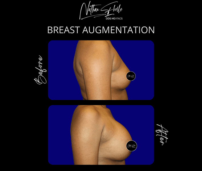 Breast Augmentation before and after - Actual Patient