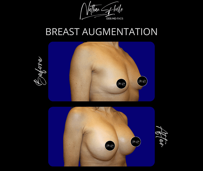 Breast Augmentation before and after - Actual Patient