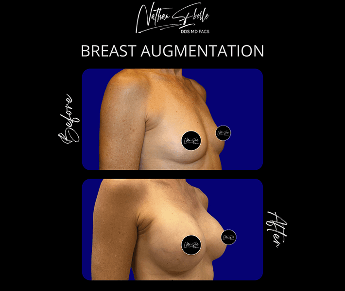 Breast Augmentation before and after - Actual Patient