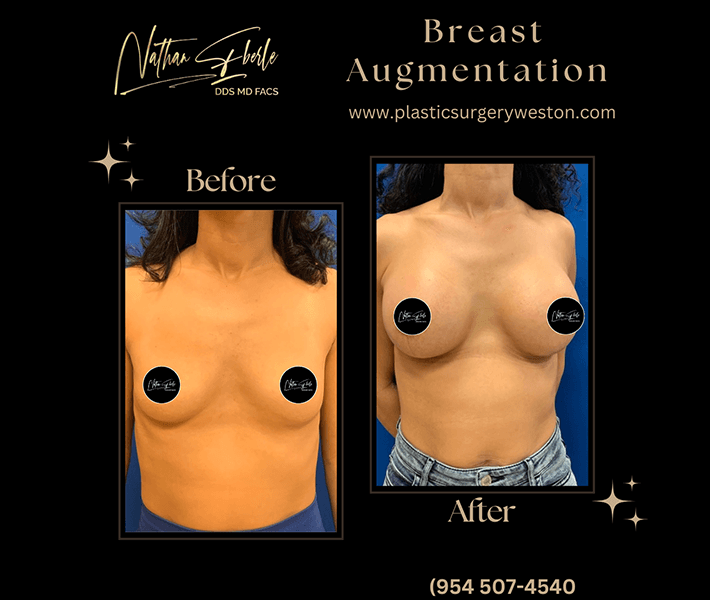 Breast Augmentation before and after - Actual Patient