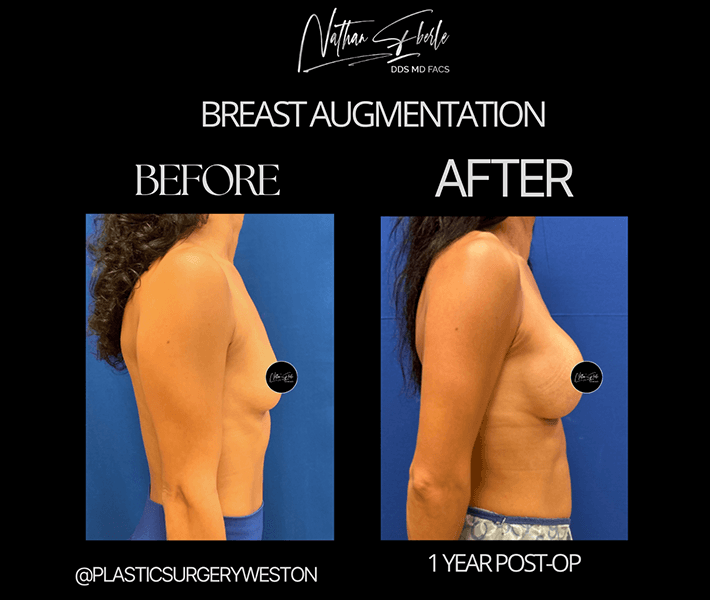 Breast Augmentation before and after - Actual Patient