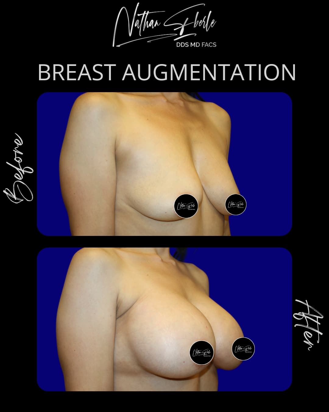 Breast Augmentation before and after - Actual Patient