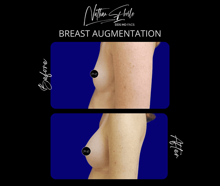 Breast Augmentation before and after - Actual Patient