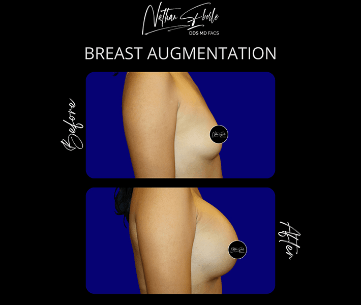 Breast Augmentation before and after - Actual Patient