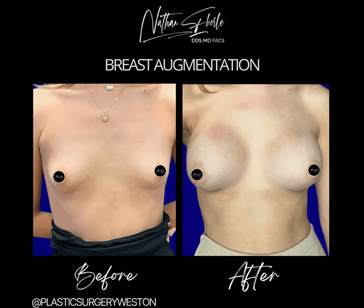 Breast Augmentation before and after - Actual Patient