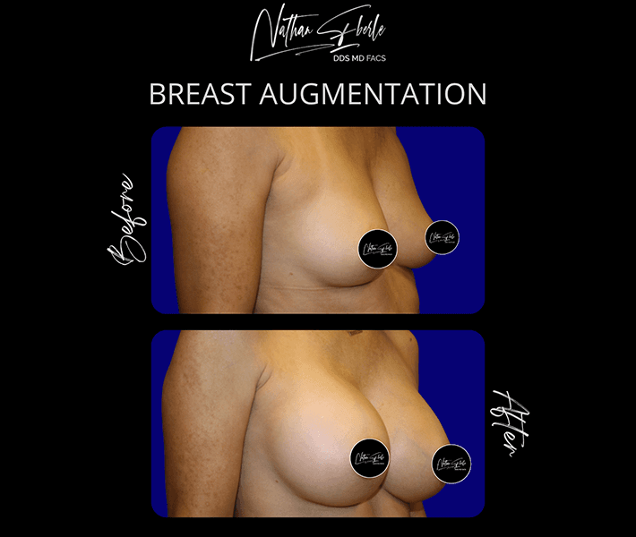 Breast Augmentation before and after - Actual Patient