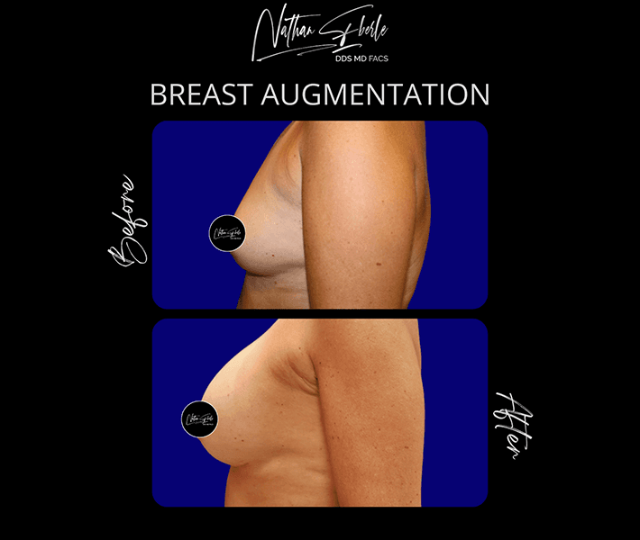 Breast Augmentation before and after - Actual Patient