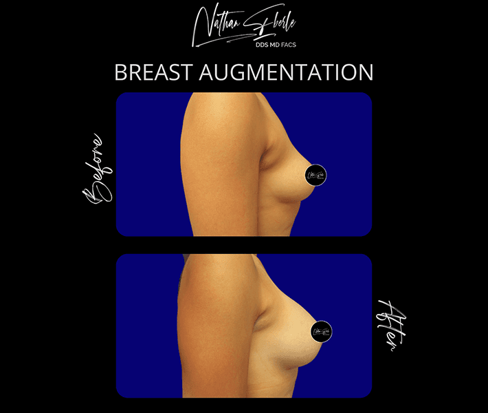 Breast Augmentation before and after - Actual Patient