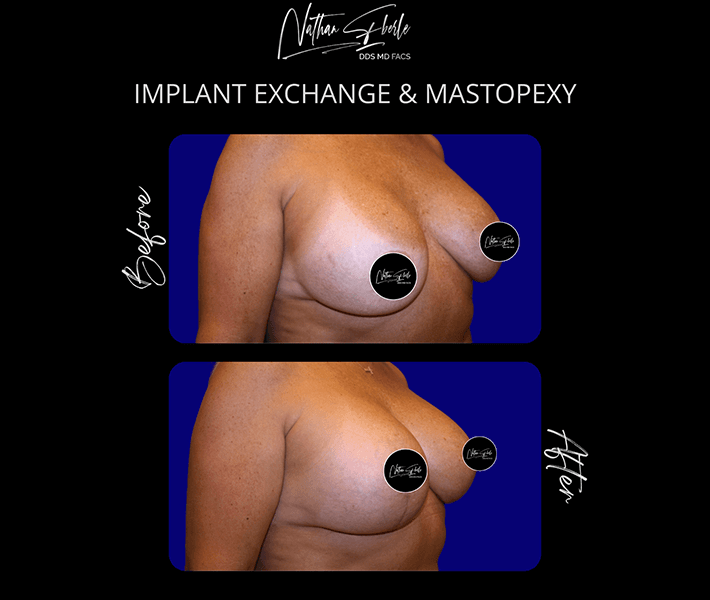 Breast Augmentation before and after - Actual Patient