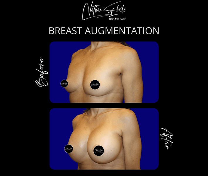 Breast Augmentation before and after - Actual Patient