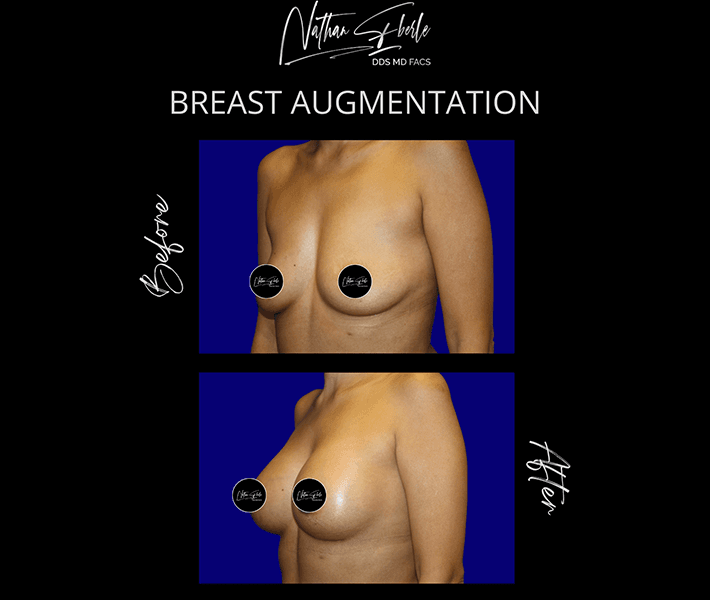 Breast Augmentation before and after - Actual Patient