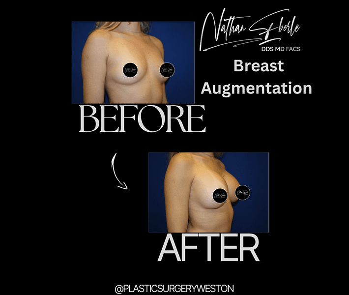 Breast Augmentation before and after - Actual Patient