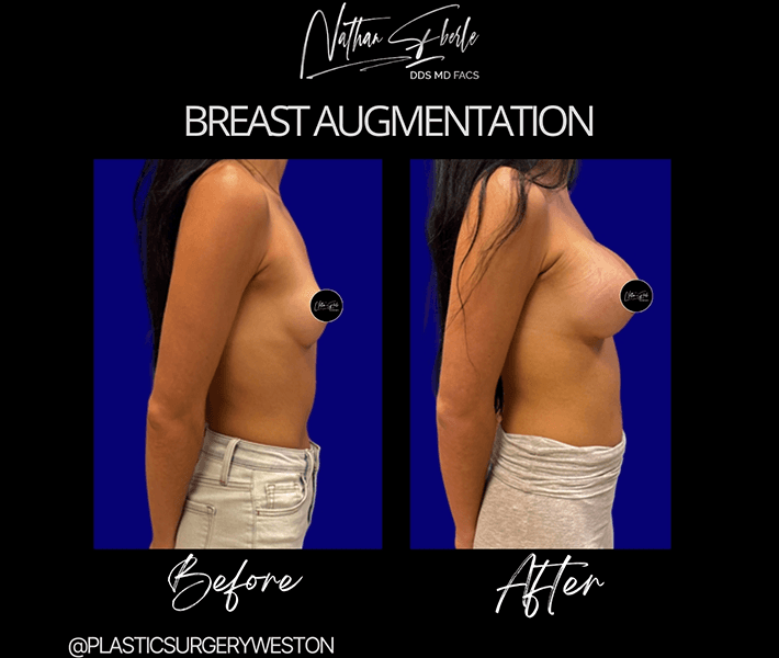 Breast Augmentation before and after - Actual Patient