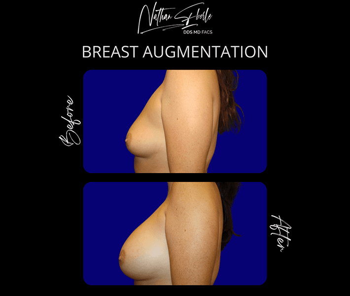 Breast Augmentation before and after - Actual Patient