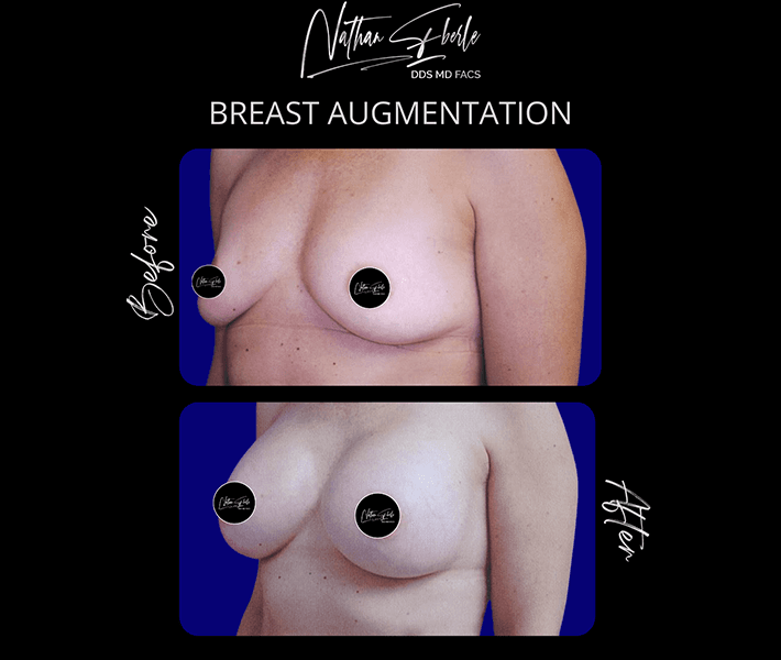 Breast Augmentation before and after - Actual Patient