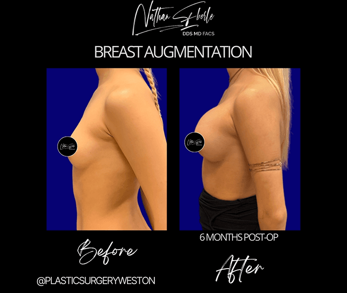 Breast Augmentation before and after - Actual Patient