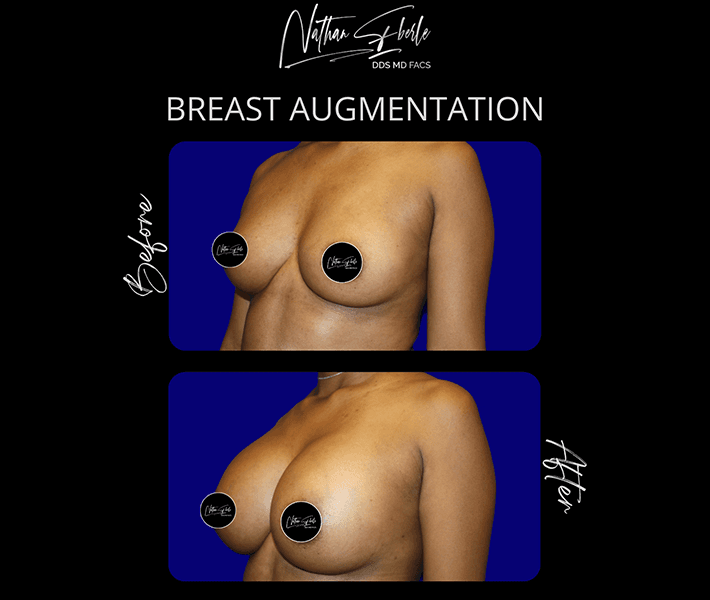 Breast Augmentation before and after - Actual Patient
