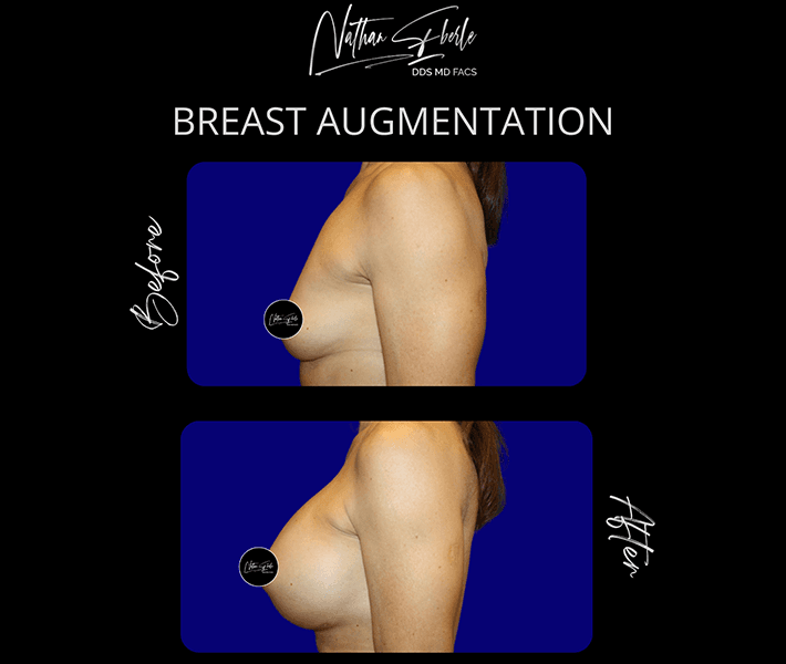 Breast Augmentation before and after - Actual Patient