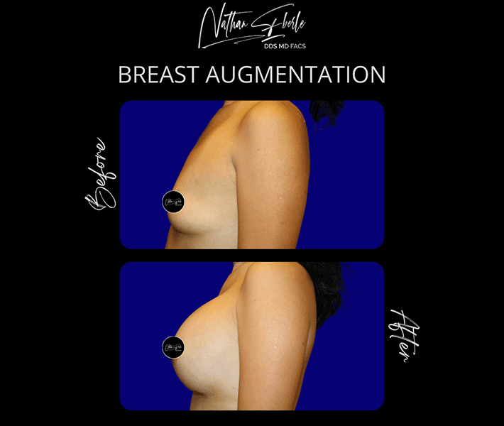 Breast Augmentation before and after - Actual Patient