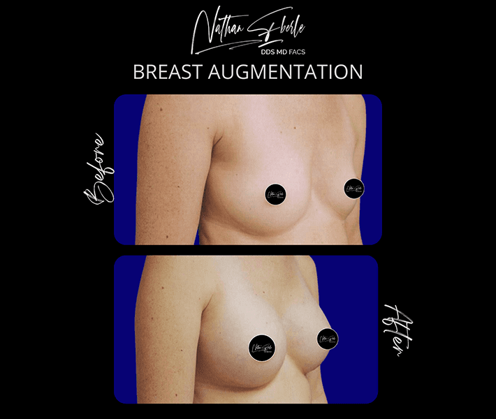 Breast Augmentation before and after - Actual Patient