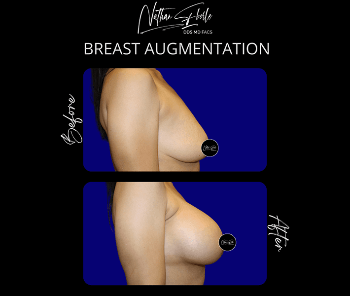 Breast Augmentation before and after - Actual Patient