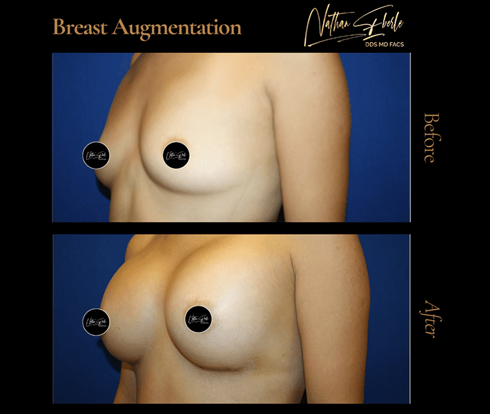 Breast Augmentation before and after - Actual Patient
