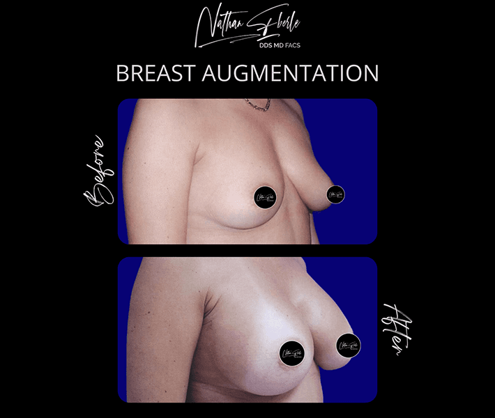 Breast Augmentation before and after - Actual Patient