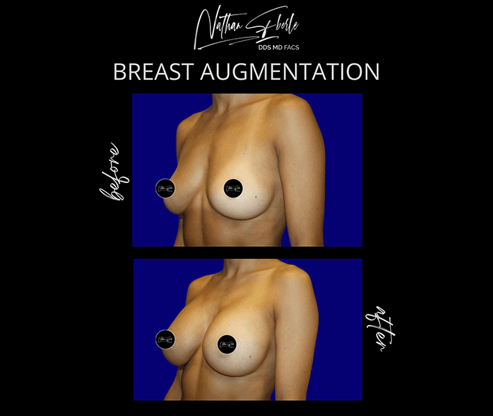 Breast Augmentation before and after - Actual Patient