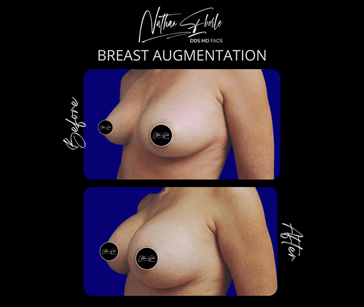 Breast Augmentation before and after - Actual Patient
