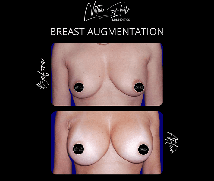 Breast Augmentation before and after - Actual Patient