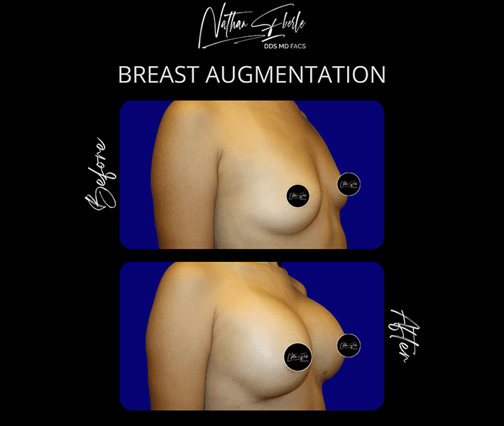 Breast Augmentation before and after - Actual Patient