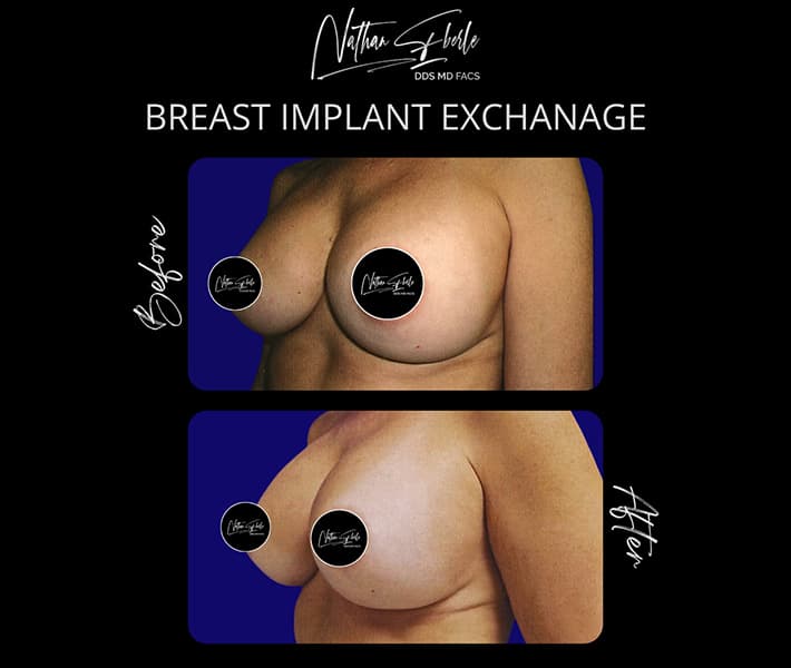 Breast Implant Exchange before and after - Actual Patient