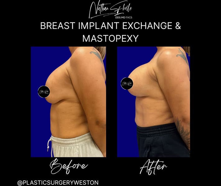 Breast Implant Exchange before and after - Actual Patient