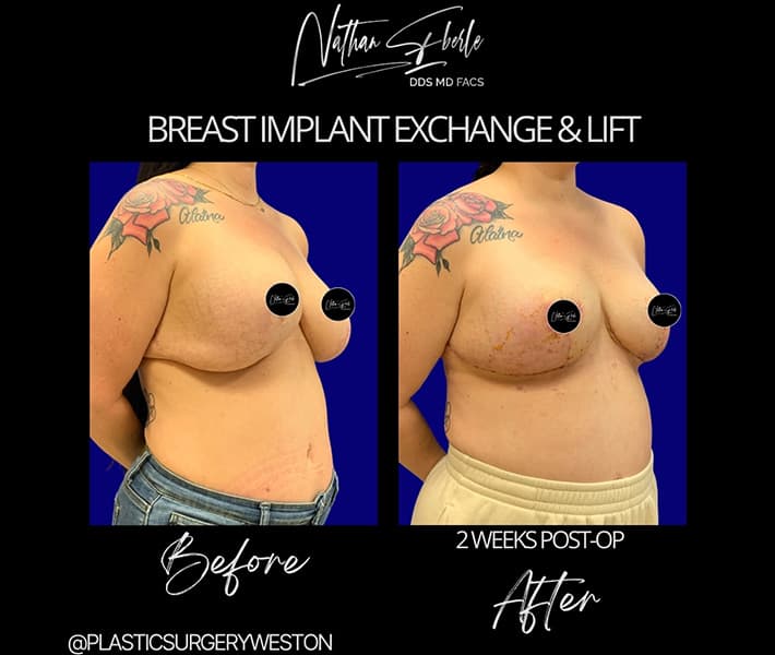 Breast Implant Exchange before and after - Actual Patient