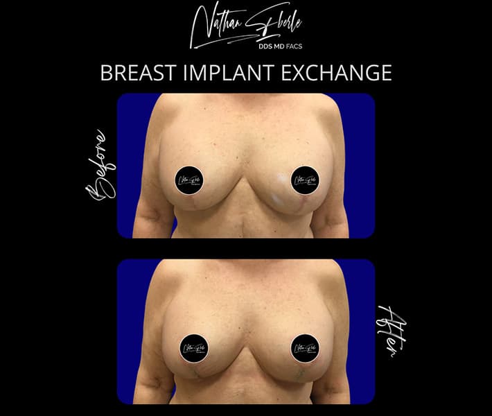Breast Implant Exchange before and after - Actual Patient