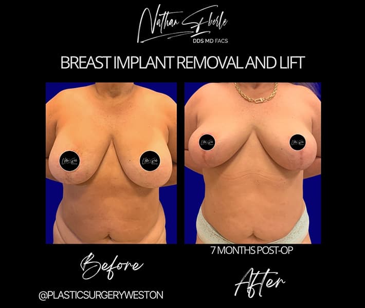 Breast Implant Exchange before and after - Actual Patient