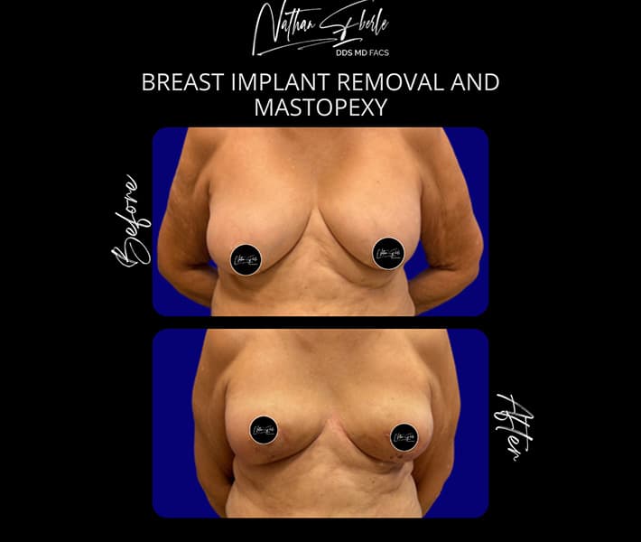 Breast Implant Exchange before and after - Actual Patient