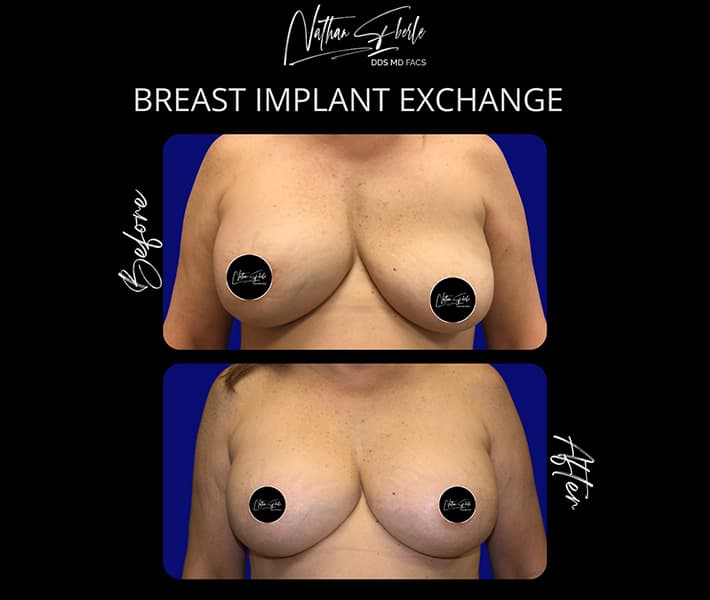 Breast Implant Exchange before and after - Actual Patient