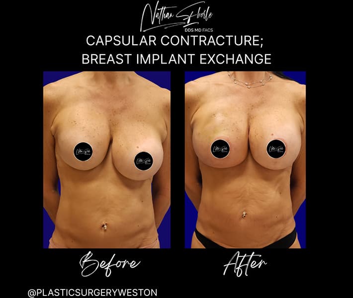 Breast Implant Exchange before and after - Actual Patient