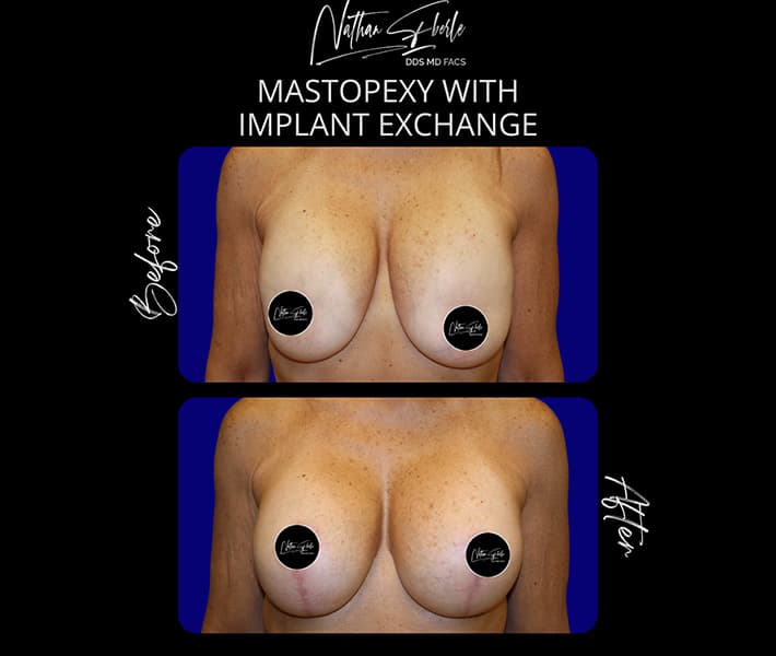 Breast Implant Exchange before and after - Actual Patient