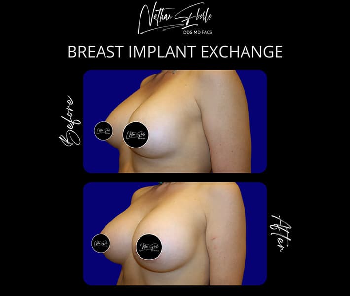Breast Implant Exchange before and after - Actual Patient