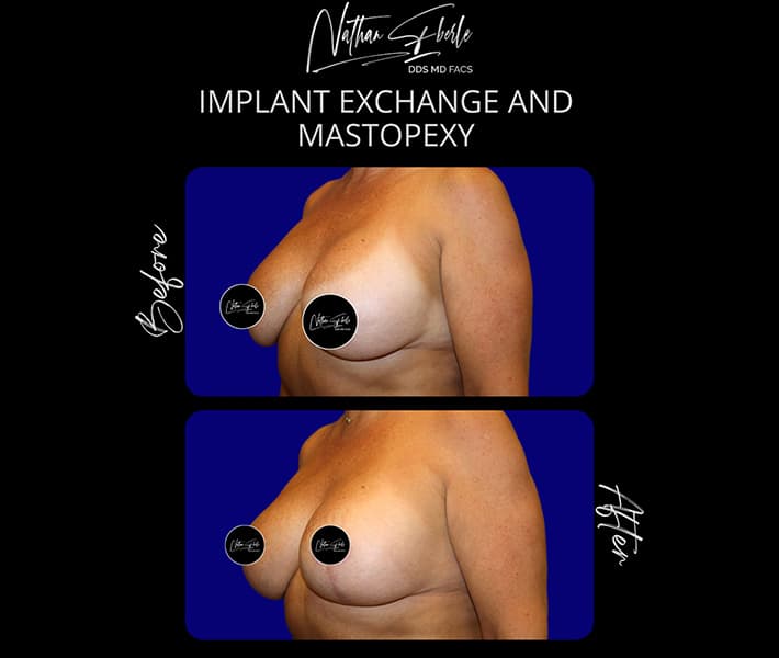 Breast Implant Exchange before and after - Actual Patient