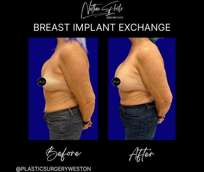 Breast Implant Exchange before and after - Actual Patient