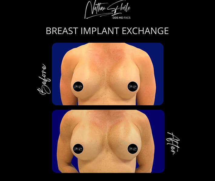 Breast Implant Exchange before and after - Actual Patient